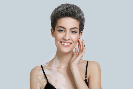 Vitiligo woman beauty portrait. Studio shot. Gray background.