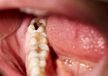 Damaged tooth with cavity dental caries decay diseaseの写真素材