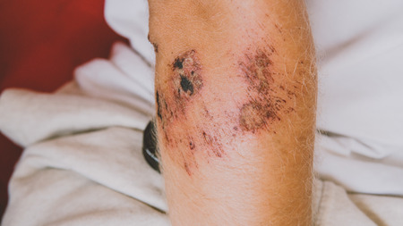 Bandaged leg after abrasion. Protect scratched body parts in travel.の写真素材
