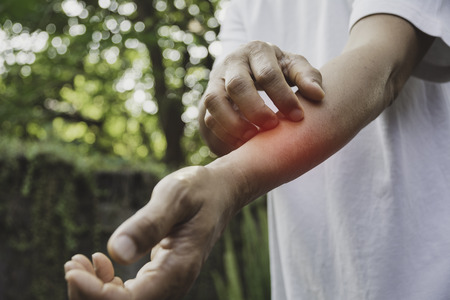 Man scratch itch with hand. Man scratching his hand healthcare concept.の写真素材