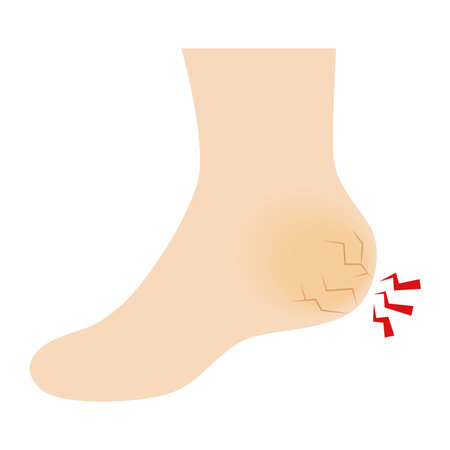 Illustration of a cracked heelのイラスト素材