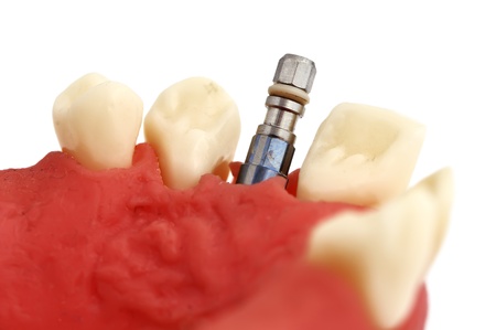 model of  jaw with implant on a white backgroundの写真素材