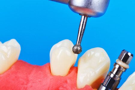 drill and dental implant in jaw, close upの写真素材