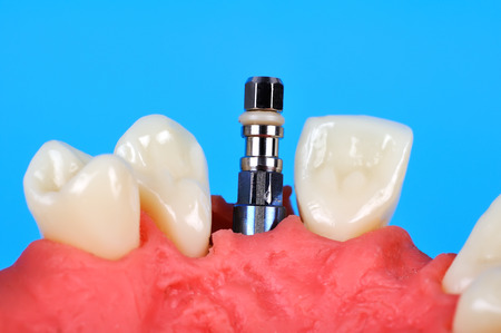 Dental implant implanted in jaw bone, close upの写真素材