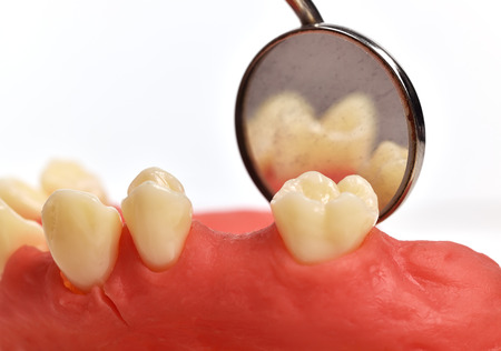 dental implant tooth and oral mirror, close up