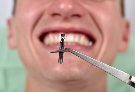 Dental implant in tweezers on a smile patient backgroundの写真素材