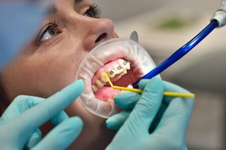 dentist prepares patient's teeth for install braces. close up