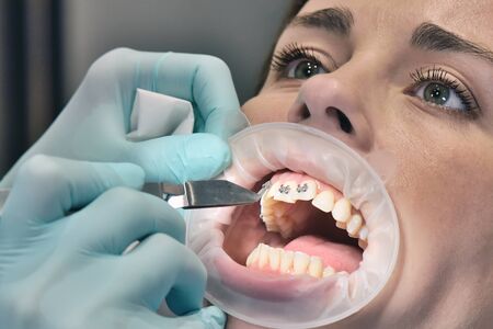 Procedure For Fixing Braces On The Teeth.  Dental Healthcare And Medical Concept. Close Up.の写真素材