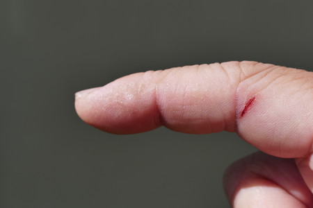 Injured finger with bleeding open cut under sunny dayの写真素材