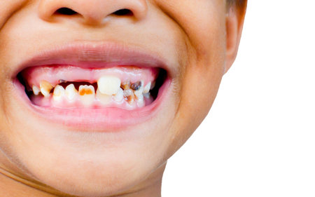 caries boy or asian Boy Tooth Decay.
