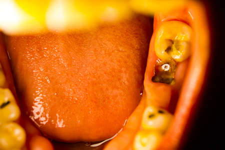 Cavities and broken teeth are painfulの写真素材