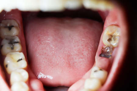 Cavities and broken teeth are painfulの写真素材