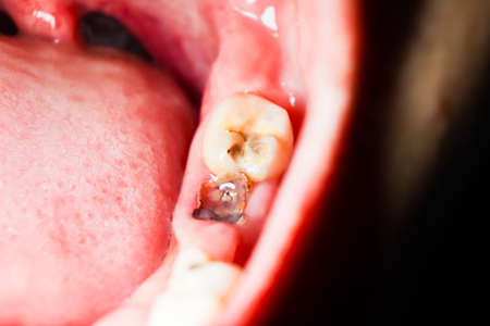 Cavities and broken teeth are painfulの写真素材