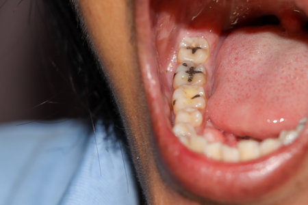 Cavities and broken teeth are painfulの写真素材