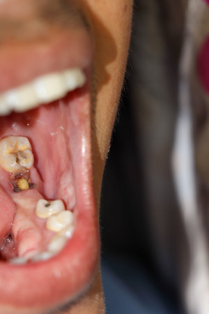 Cavities and broken teeth are painful