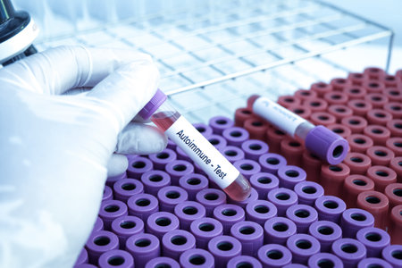 autoimmume test to look for abnormalities from blood,  blood sample to analyze in the laboratory, blood in test tubeの写真素材