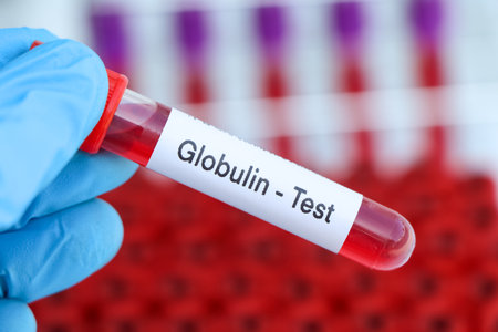 Globulin test to look for abnormalities from blood,  blood sample to analyze in the laboratory, blood in test tubeの写真素材