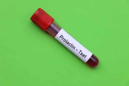 Prolactin test to look for abnormalities from blood,  blood sample to analyze in the laboratory, blood in test tubeの素材 [FY310202881052]