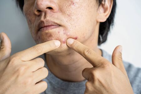 Young asian man with problematic from acneの写真素材
