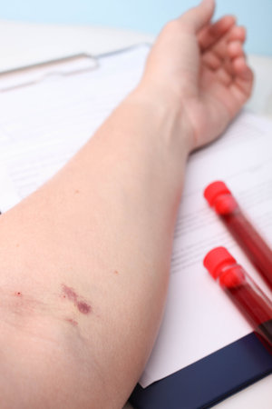 Female hand with a bruise after taking blood from a vein. Analysis concept.