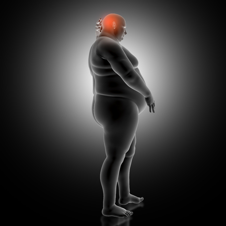 3D render of a medical background with overweight man holding head in painの写真素材