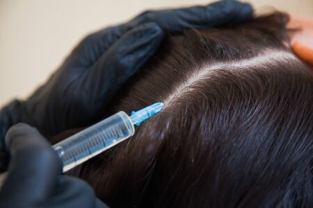 Unrecognizeble female person at trichologist office get injections in head skin. Doctors hands holding disposable syringe under patients head. Porcedure against hair loss and for skin health.の写真素材