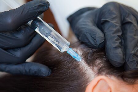 Unrecognizeble female person at trichologist office get injections in head skin. Doctors hands holding disposable syringe under patients head. Porcedure against hair loss and for skin health.の写真素材