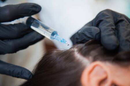 Unrecognizeble female person at trichologist office get injections in head skin. Doctors hands holding disposable syringe under patients head. Porcedure against hair loss and for skin health.の写真素材