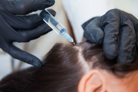 Unrecognizeble female person at trichologist office get injections in head skin. Doctors hands holding disposable syringe under patients head. Porcedure against hair loss and for skin health.の写真素材