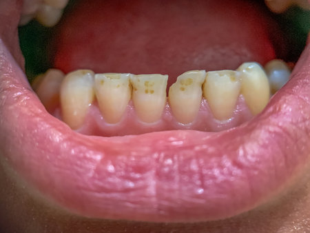 teeth requiring treatment by a dentist. teeth with chips and plaqueの写真素材