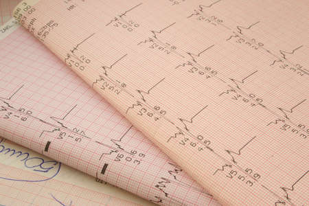 cardiological test results #2の写真素材