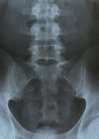 pelvis x-rayの写真素材