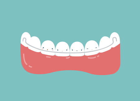 Retainer teeth, dental concept.のイラスト素材
