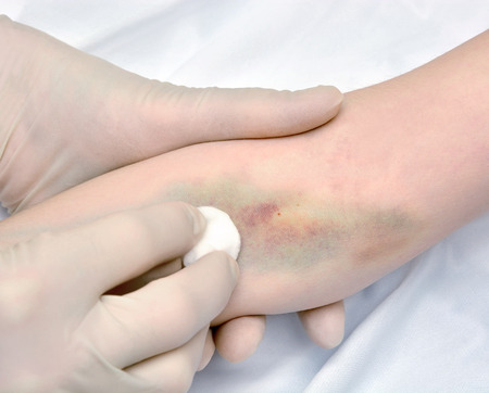 Damage to the skin after medical injections. Medical error. Addiction