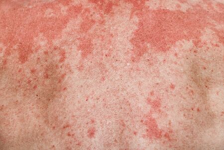Background of human skin with allergic red spots. Skin reaction to allergic products. Diseases on...