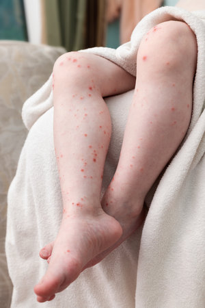Skin rash on the legs of a small child. Acute viral disease of coxsackie. Ulcers from scratching. Allergic reaction.の写真素材