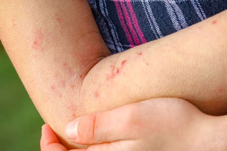 wounds atepic dermatitis in the hands of a child
