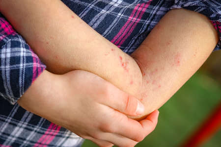 wounds atepic dermatitis in the hands of a childの写真素材