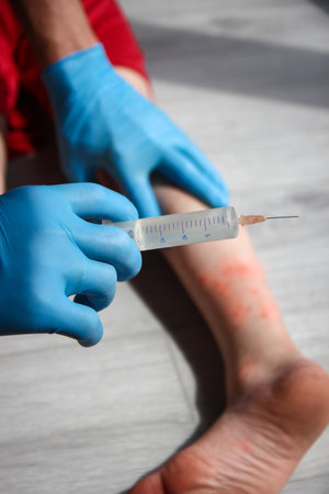 atopic dermatitis on the legs of a child treatmentの写真素材
