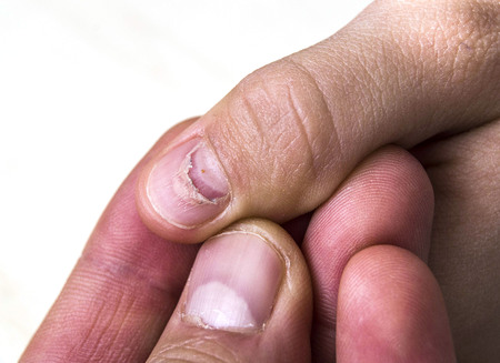 nail re-emergence in children, hand foot disease and nail health, nail care and health in children.