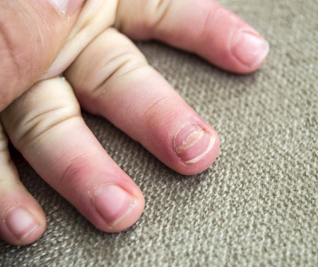 nail diseases in children, nail diseases in small babies,の写真素材