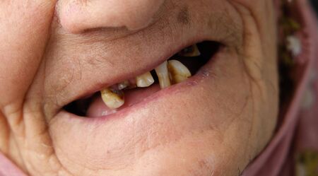 old woman without teeth, old woman with a few teeth in her mouth,の写真素材