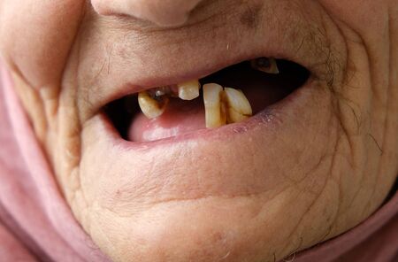 old woman without teeth, old woman with a few teeth in her mouth,の写真素材
