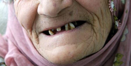 old woman with spilled teeth
