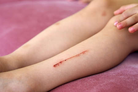 a scratch wound that forms a trace on the leg, the child's leg is injured,の写真素材