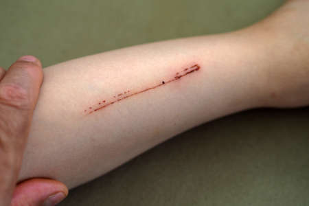 a scratch wound that forms a trace on the leg, the child's leg is injured,の写真素材