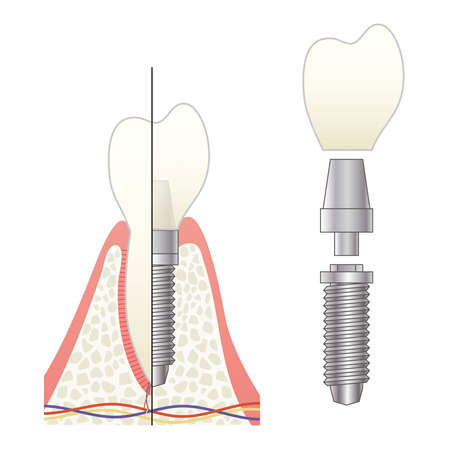 Implant structural illustrationのイラスト素材