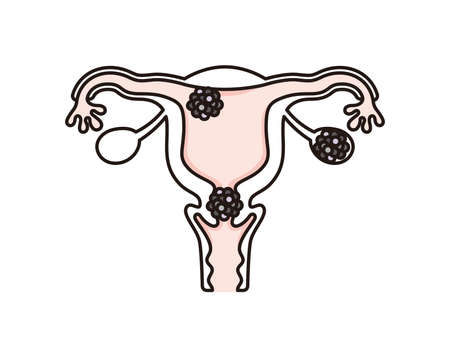 Illustration of the site of uterine cancerのイラスト素材