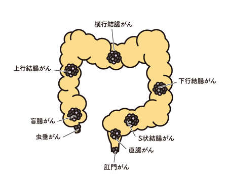Illustration of the cancer site of the large intestine