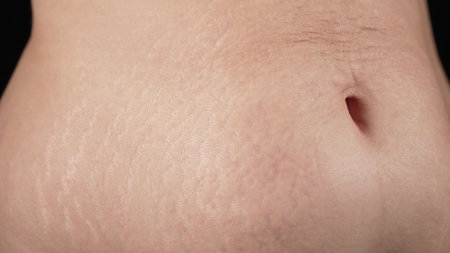 Woman showing stretch marks on abdomen after pregnancy. Natural body textureの写真素材